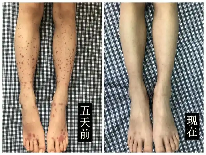 前几天收入院一个过敏性紫癜的小女孩,8岁,发病前1周得了疱疹性咽峡炎