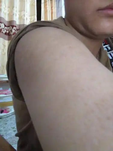 不痛不痒的,摸起来没有颗粒感,不是鸡皮肤,看过医生了,说是毛孔堵塞