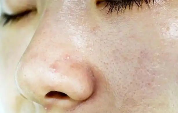 皮肤毛孔粗大似大妈,平时多做这4点,收缩毛孔皮肤细腻