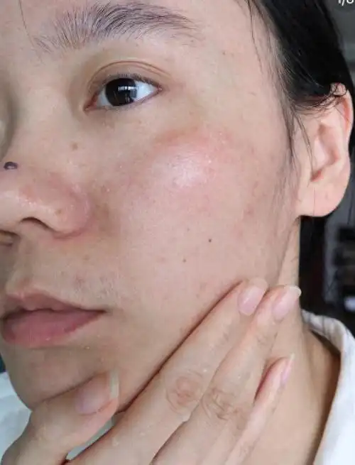 公认好用的5款"敏感肌"好物:理肤泉痘痘救急,春娟价格良心