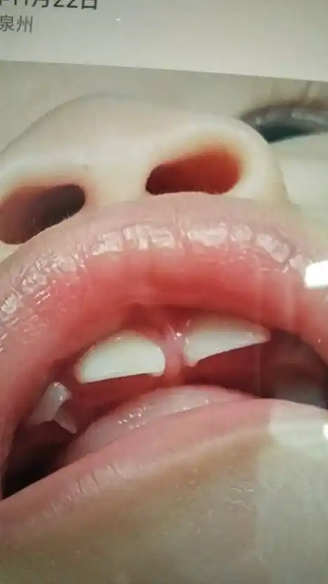 我家宝宝9个月了,最近牙齿旁边长了一个牙钉呈90