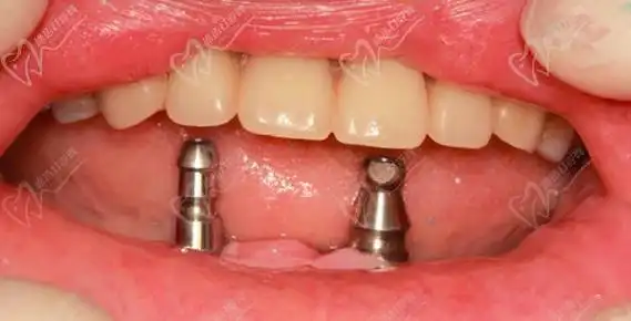 半口半固定种植牙2颗植体