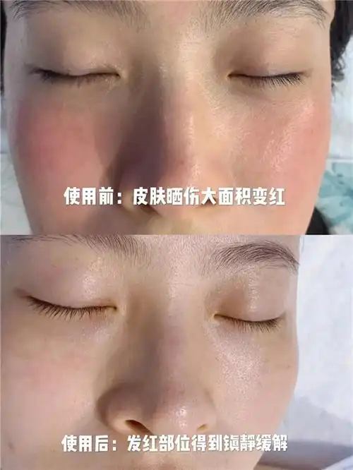 品牌新闻 品牌新闻 正文使用对比图   使用前:皮肤晒伤大面积变红.