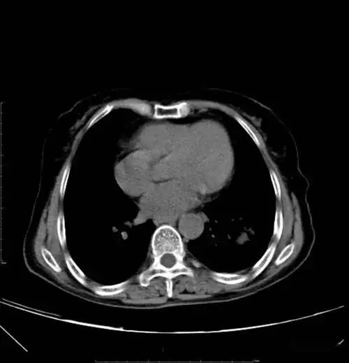 胸部ct平扫示左下肺占位——肺癌_淋巴结