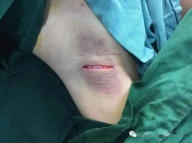 一举清新微创腋臭切除术小切口解决大尴尬