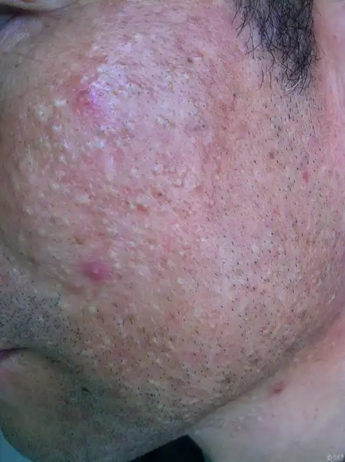 帮诊断下此顽固面部皮肤病顺便给个药方谢谢