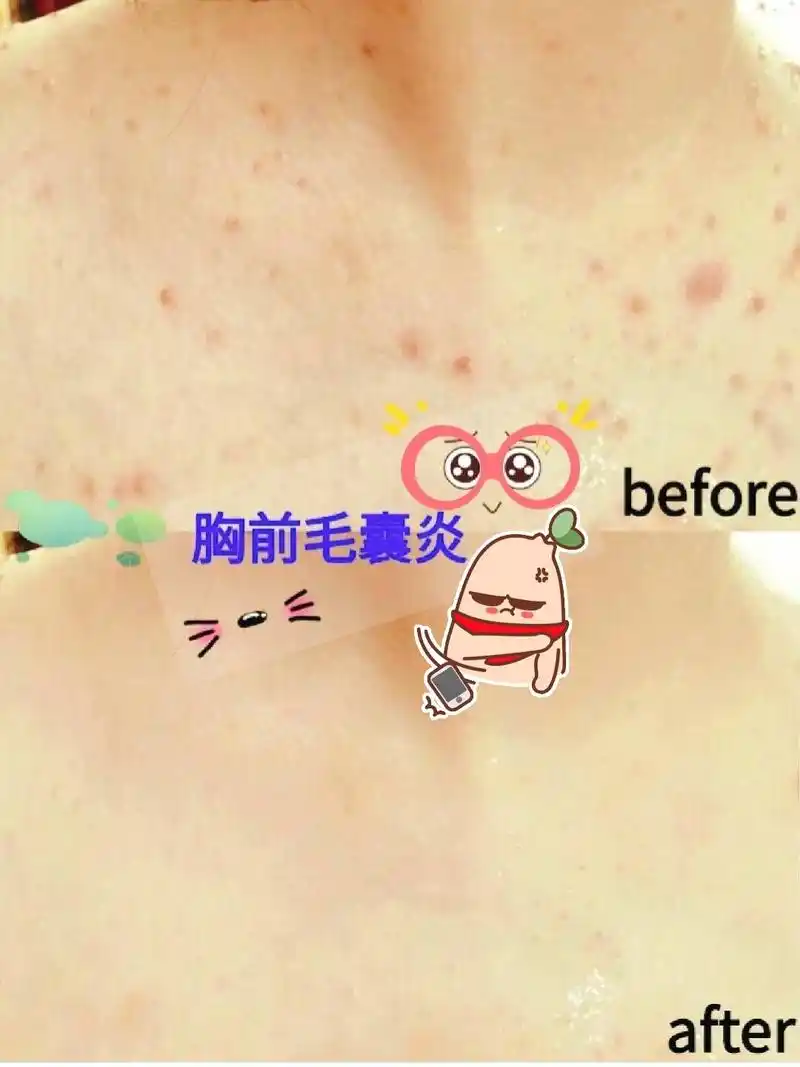 胸前毛囊炎该怎么办71