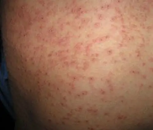 孕妇疥疮初期腹部皮肤症状图片