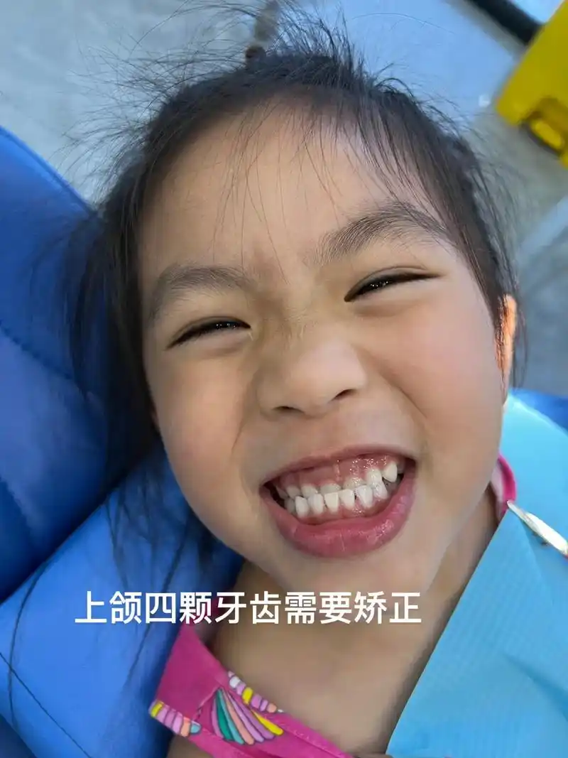 儿童地包天矫正记录