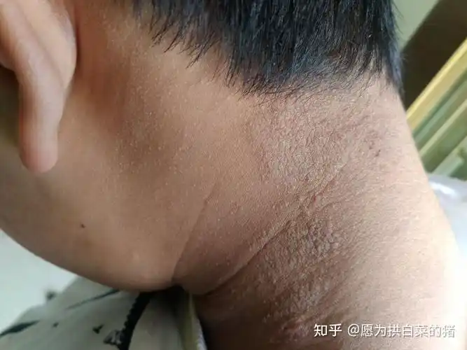 孩子脖子上好像起癣了请大家看看是什么东西