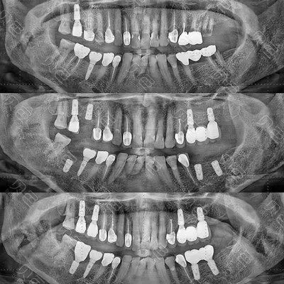 种植牙影像图