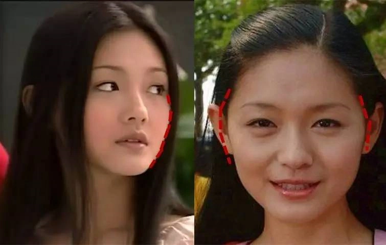 这种情况是颧骨宽.