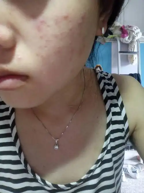 两边脸上都有痘痘,一夜之间爆发的,以为是护肤品过敏就停用了,用以