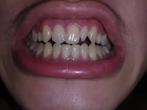 门牙和虎牙中间长出一个颗尖牙,现在我都20岁了能矫正吗?