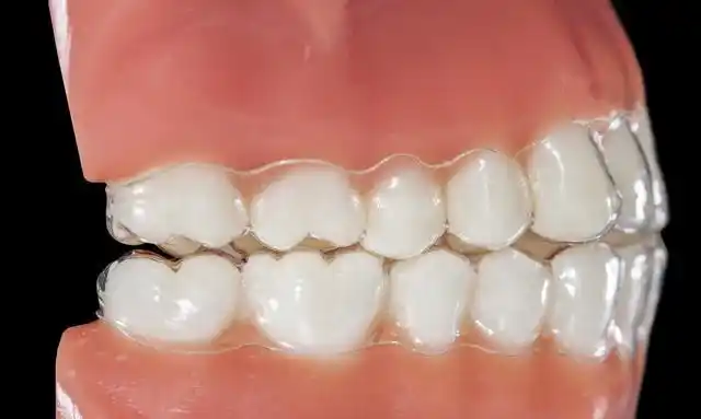 导语:上颌尖牙埋伏阻生是临床上较常见的错颌畸形,其病因复杂,类型多