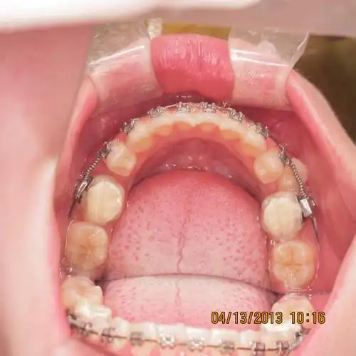 下颌阻生双尖牙矫治一例