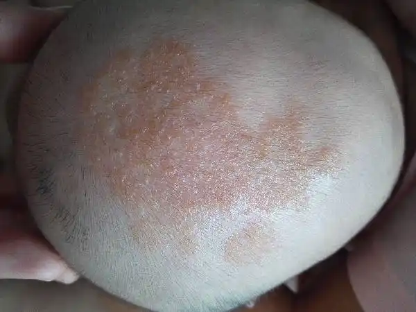 长春肤康医院浅谈:哪些部位更爱长湿疹?