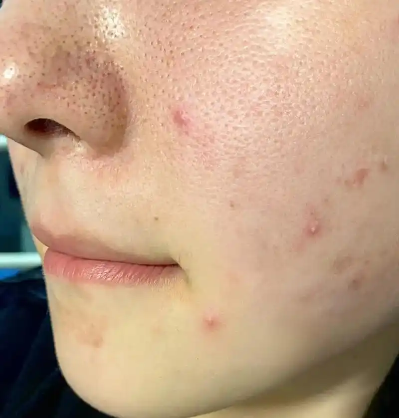 去了趟97,才知道毛孔粗大不用担心!说实话,要不是去了一趟专 - 抖音