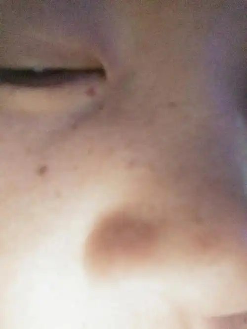 下眼皮长小红点是怎么回事