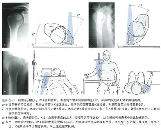 肱骨近端骨折的治疗原则