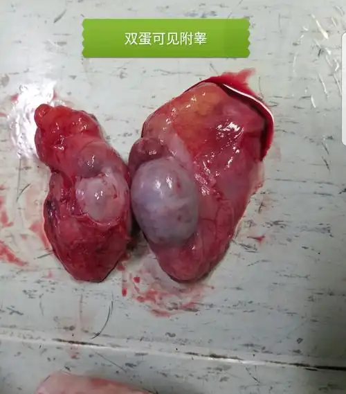 睾丸坠胀的常见原因有哪些睾丸疼痛怎么办