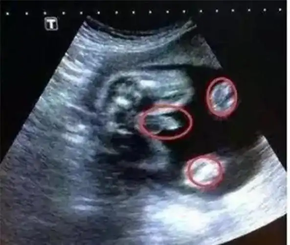 女宝b超双腿间有个圆球b超看男女揭秘