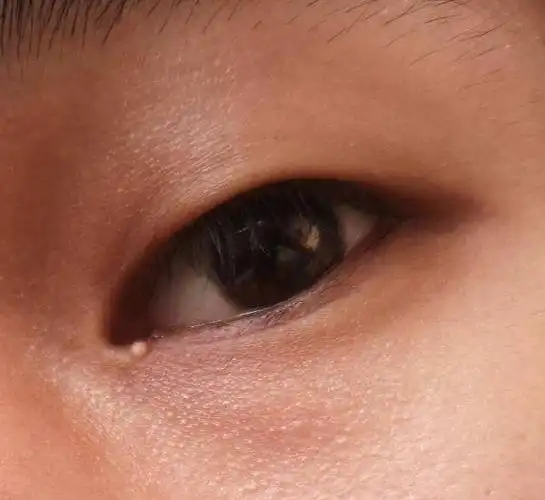 眼角长了个小疙瘩图片