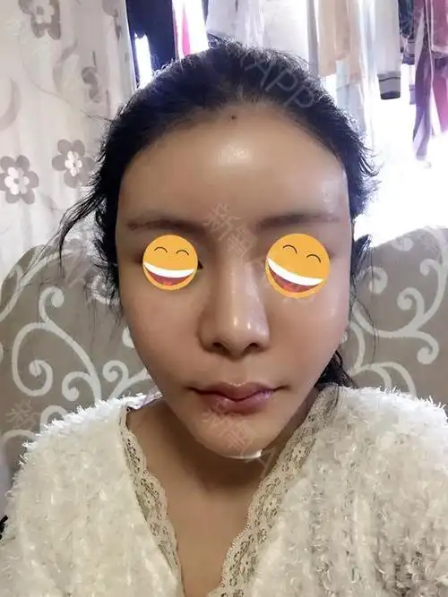 新氧- 一恩 | 面部轮廓 | 美体塑形 | 额头 | 自体脂肪填充额头