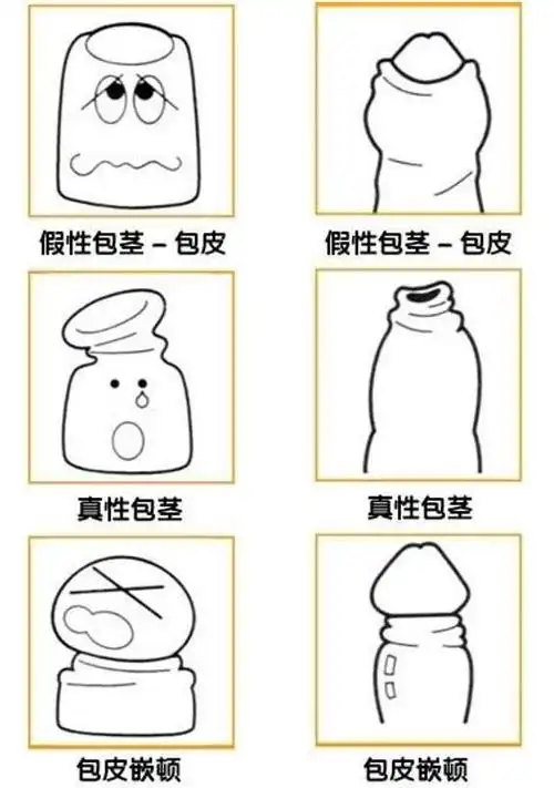 包茎又分为假性包茎和真性包茎.