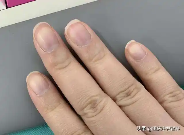 头条问答 - 心脏不好指甲会有什么特征?(69个回答)