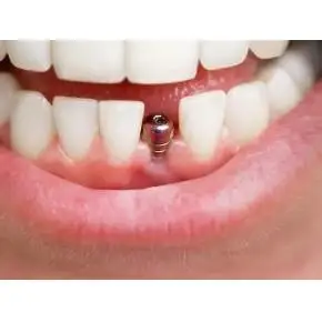 牙齿种植体螺钉起的一类医疗器械报备的前提和步骤