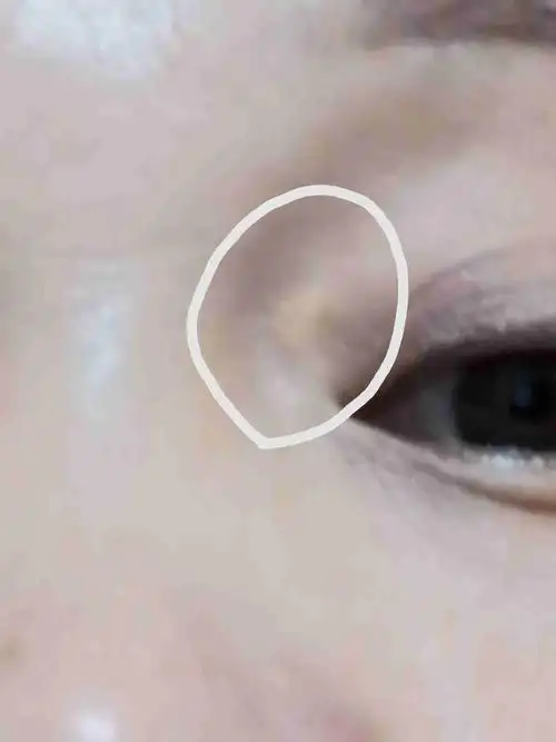 这个长眼角的是什么啊?不会湿白癜风吧