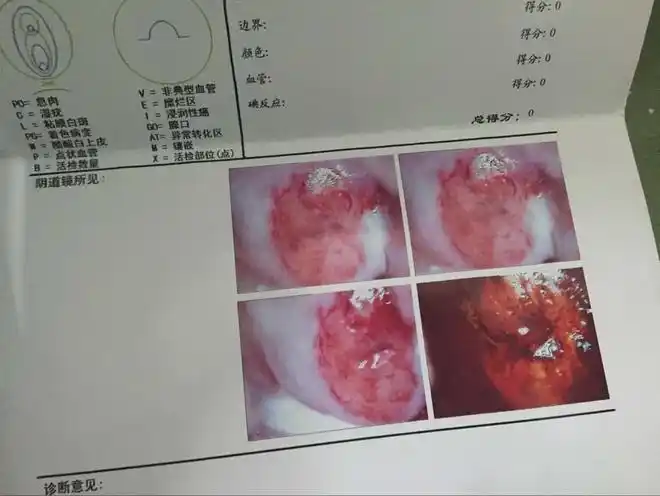 妇科炎症的吹哨人白带