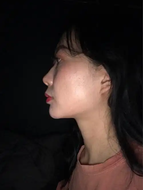 面中凹陷侧脸没法看