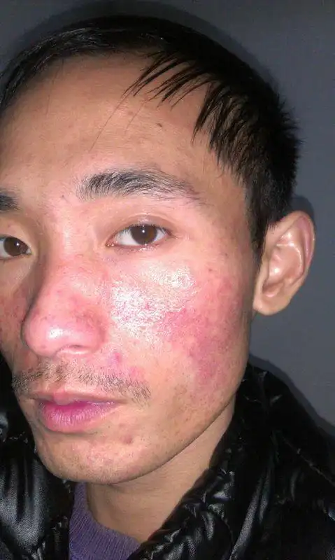 脸部两边红红火火的会有点痒这是什么皮肤病