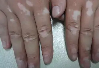 如何治疗青少年白癜风较好