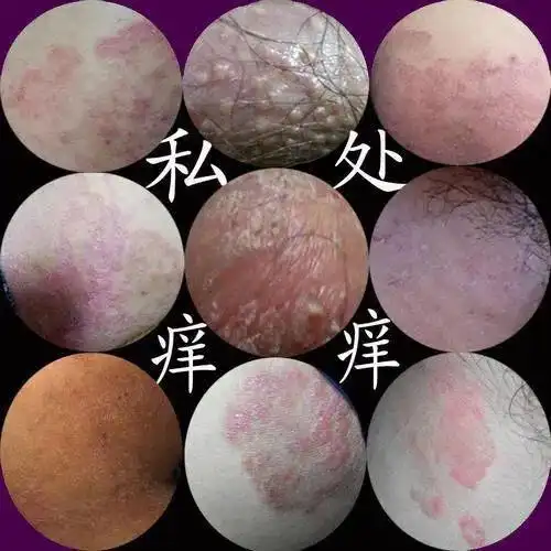 【京东大药房直发】睾丸瘙痒蛋蛋瘙痒阴囊炎体股藓大腿内侧股癣阴囊