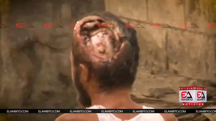 castro silva),疑似因卫生欠佳而遭寄生虫寄生,最后头皮竟被超过4