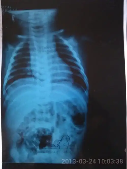 小孩两个月了,不发烧,偶尔咳两下,拍片子诊断为支气管肺炎,医请各位