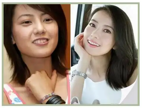 高圆圆牙齿对比图