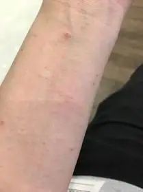 疥疮的最初症状图片