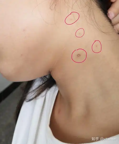 请问脖子上的小肉粒这是什么?
