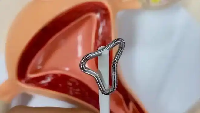 它的使用年限在10~15年之间,而带铜无支架的节育环,使用年限通常为5~8