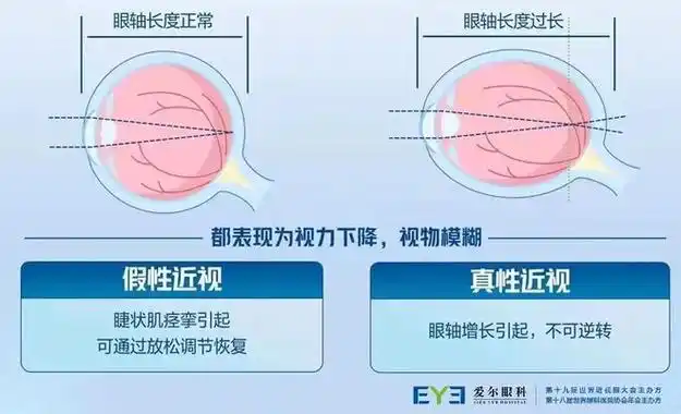 远视|屈光|眼轴|近视眼|高度近视_网易订阅