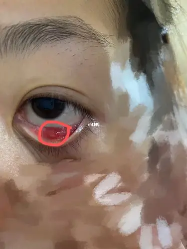 下眼皮子里面长了一颗黄色的水泡一样的东西