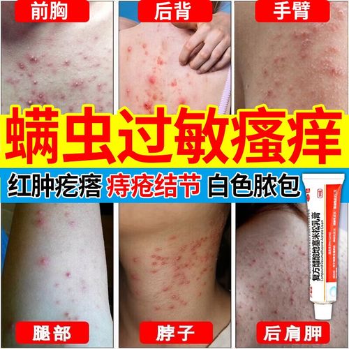 螨虫药膏螨虫过敏引起的背部后背毛囊炎 除螨祛痘胸部脸部螨虫过敏