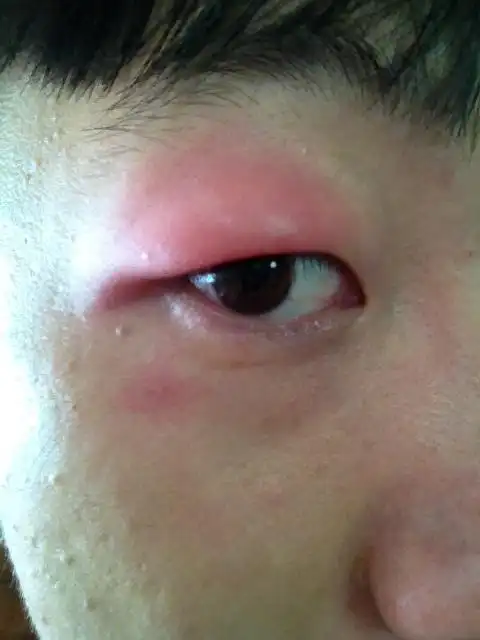 眼睛肿是否药物过敏?