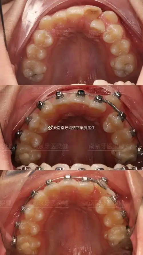 929292上颌尖牙是除第三磨牙外最易阻生的恒牙,患病率为1%-3%