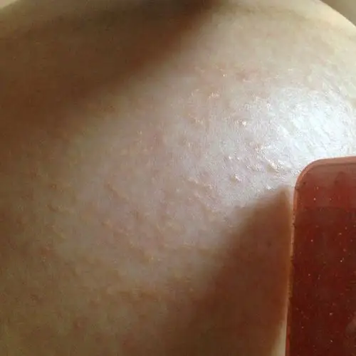 怀孕38周肚皮痒长了可多像泡泡一样的东西,这肚皮上长的什么东西,影响