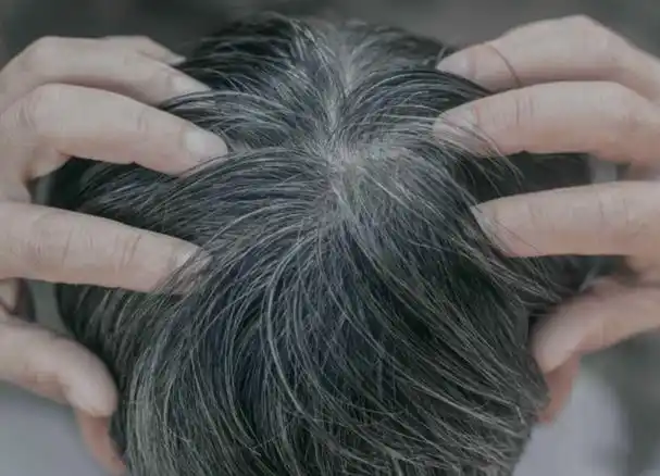 真实情况是一根白发长一根!